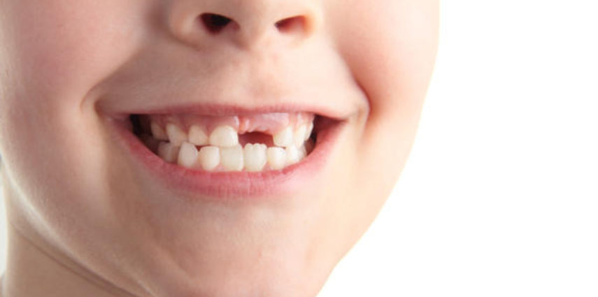 Do You Miss Your Missing Teeth?