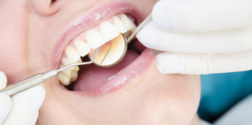 A Look At Fillings